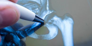 Arthritis