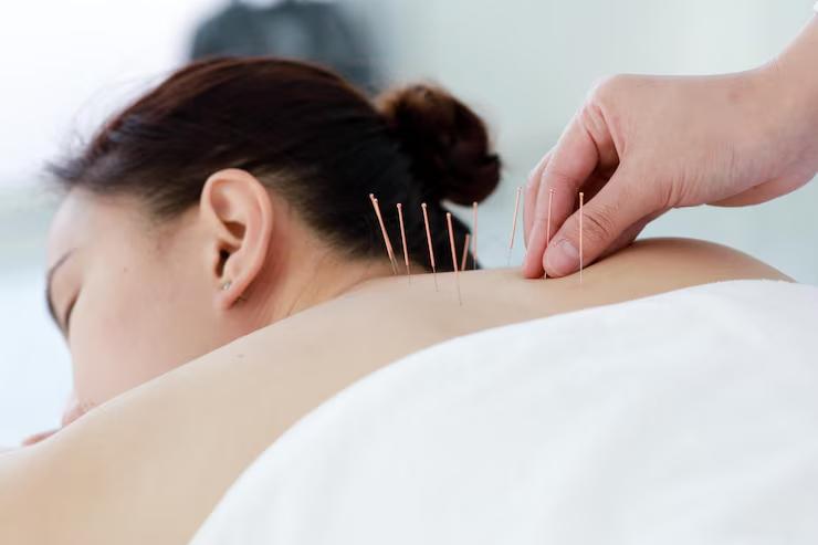 Acupuncture for Pain Relief in East Auckland – Natural Healing at Motion Lab